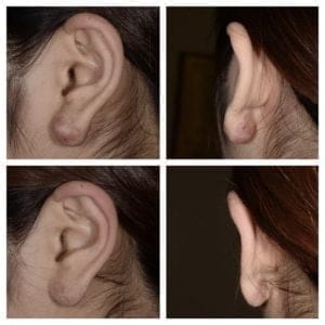蟹足腫治療