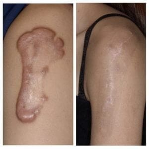 蟹足腫治療成功