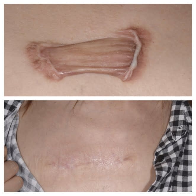 蟹足腫根治