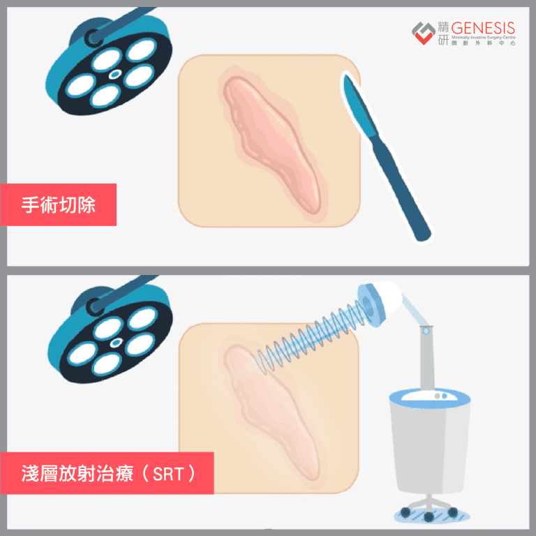 香港蟹足腫放射治療