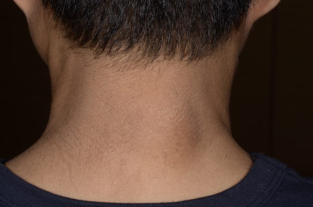 lipoma removal